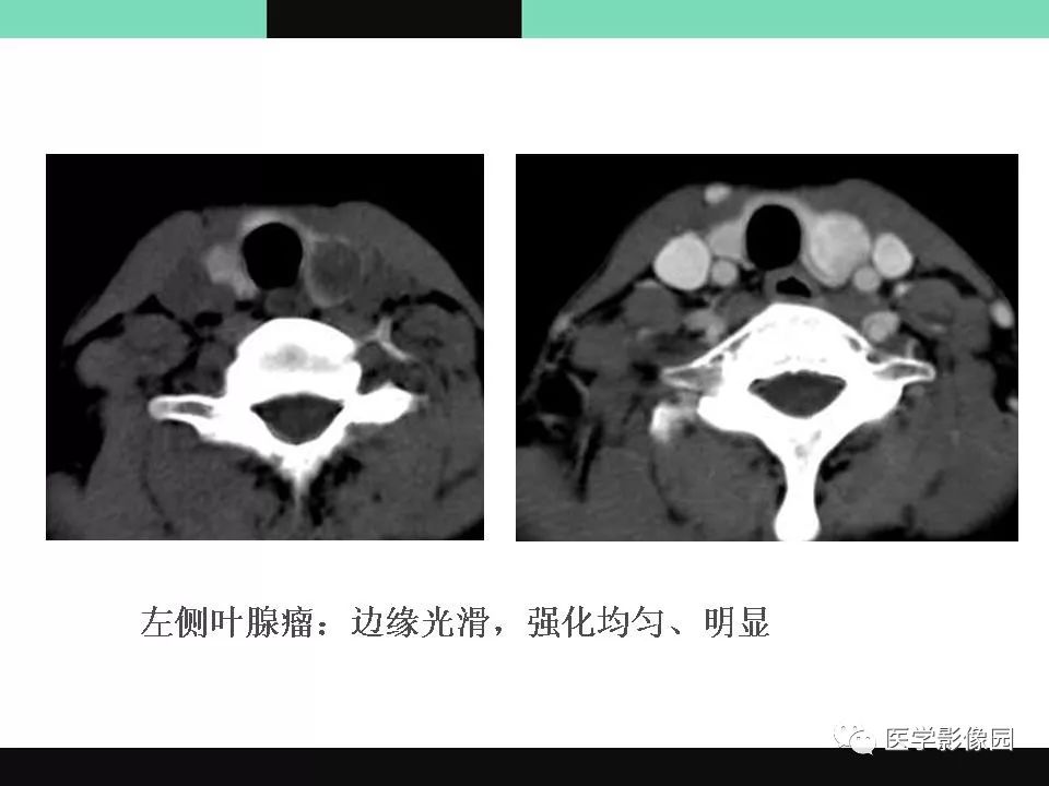 常见甲状腺结节的ct诊断