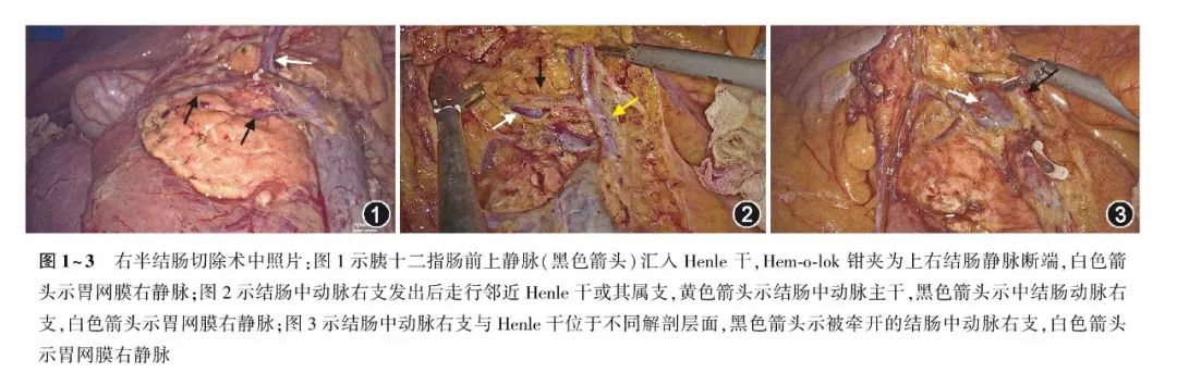 其行程中也接受胰十二指肠前上静脉的汇入[5],成为henle干的经典解剖