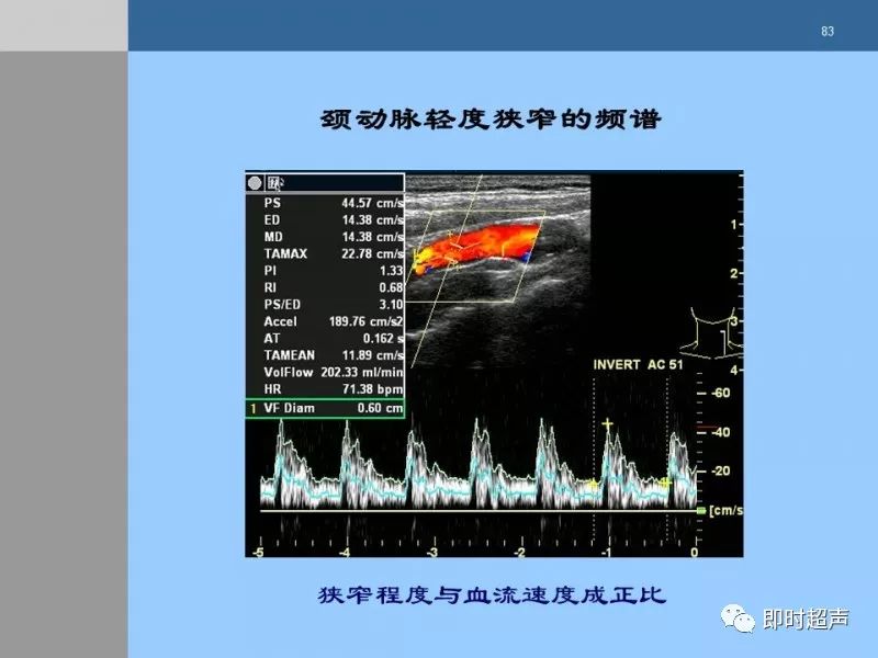 颈动脉硬化的超声评估