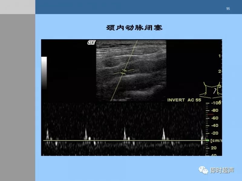 颈动脉硬化的超声评估