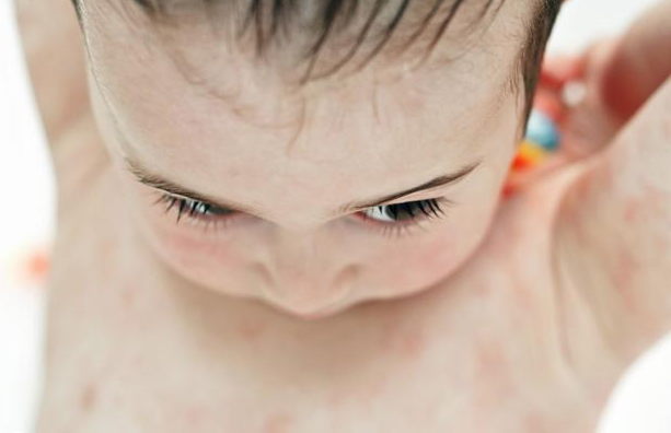 【小儿荨麻疹】小儿荨麻疹症状及治疗方法_小儿荨麻疹怎么办