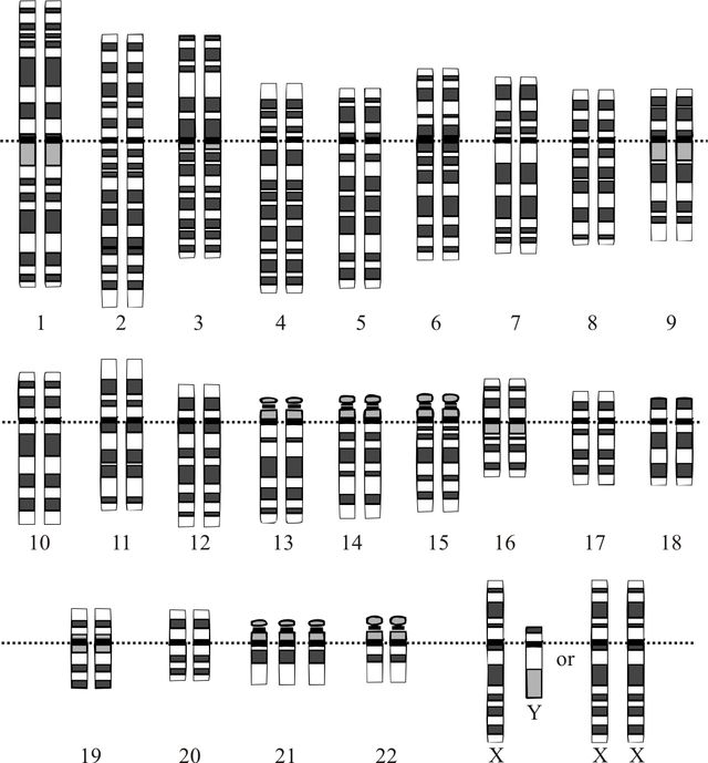 21-三体综合症患者的核型:第21对染色体的三体变异现象   national