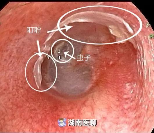 此案例中,侵入小慧耳内的是一条白色,透明且粗细仅如缝线的虫子.