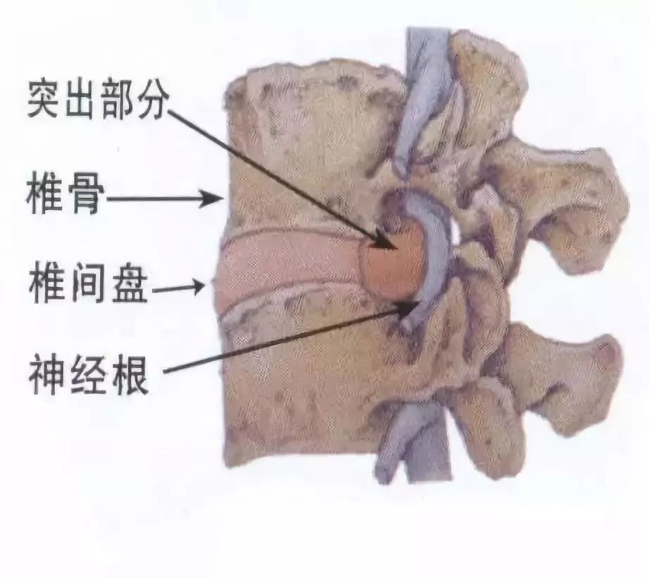 长圆针治疗腰椎间盘突出是什么原理(3)