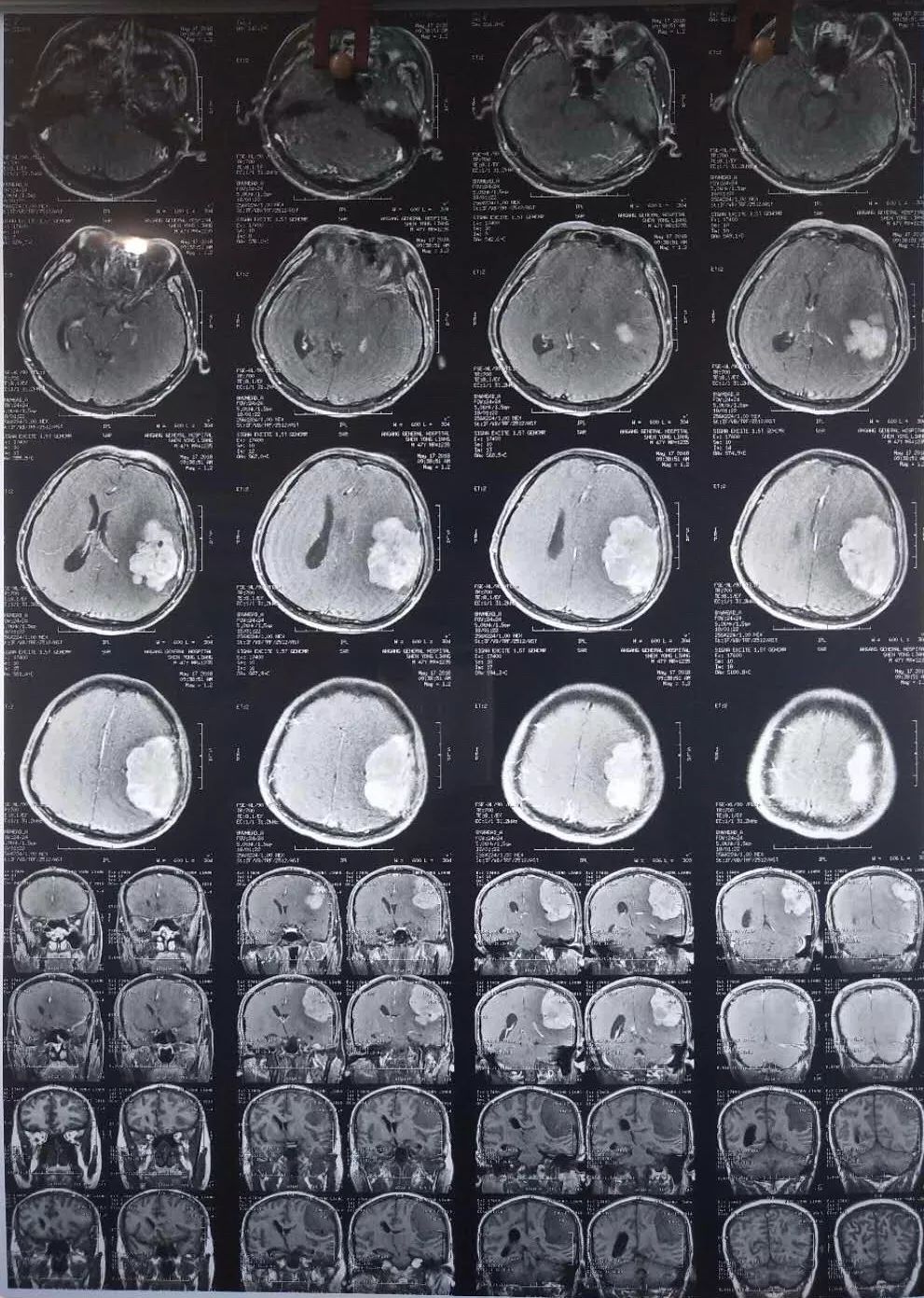 经吴成城主任阅片考虑巨大脑膜瘤,肿瘤周边为语言及运动功能区,如手术