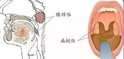 扁桃体腺样体调理误区有哪些?