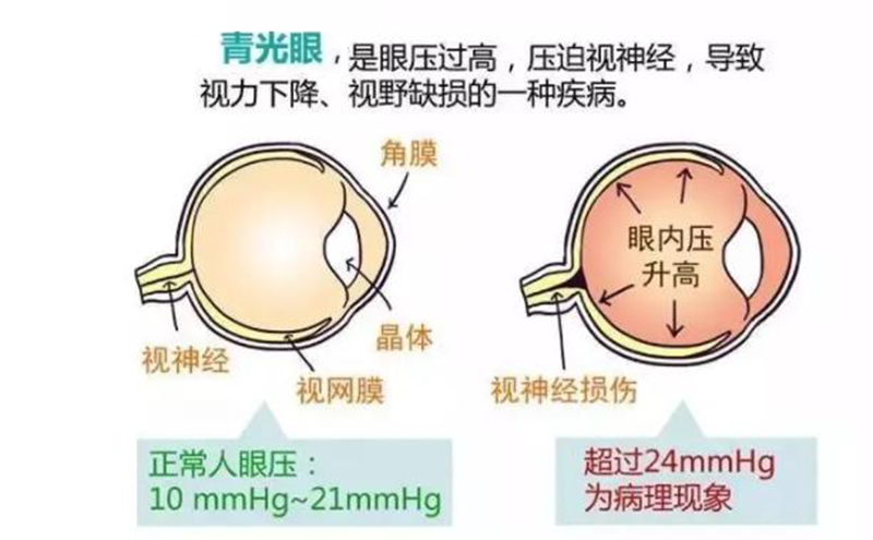 "真实版你是我的眼"感动你有,青光眼致盲不可逆,你