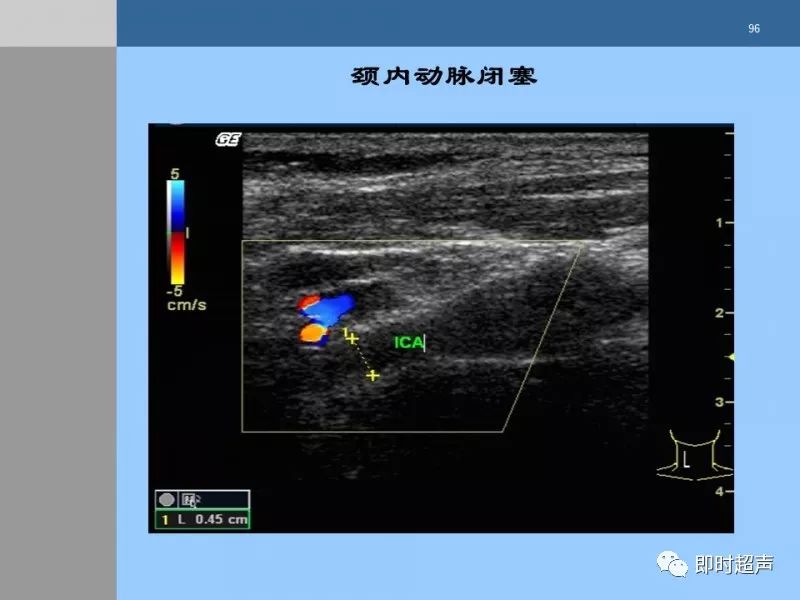颈动脉硬化的超声评估