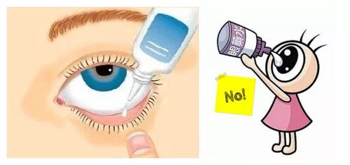 同样道理,眼膏或眼用凝胶也应涂在结膜囊内.