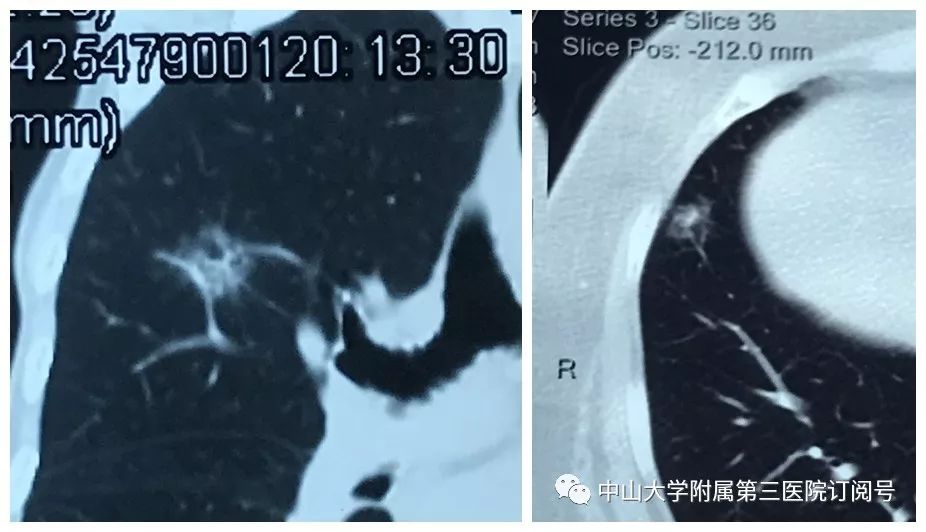 肺部小结节是指通过肺部ct检查发现的直径在10 mm左右的结节病变.