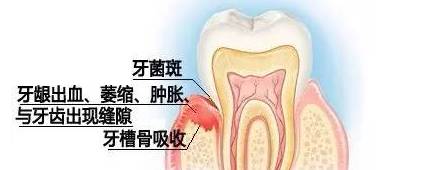 牙龈炎:肿么办?