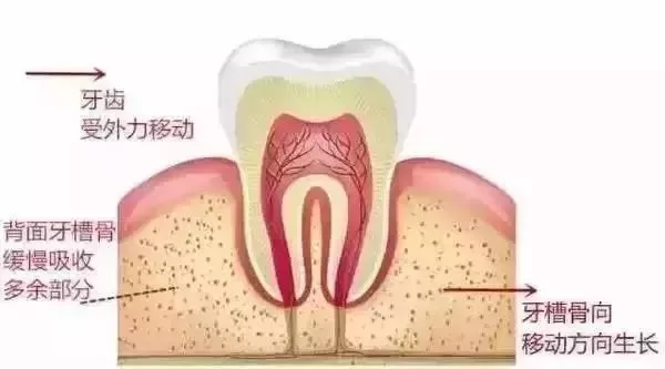 正畸牙齿移动的原理_正畸中牙齿移动的原理