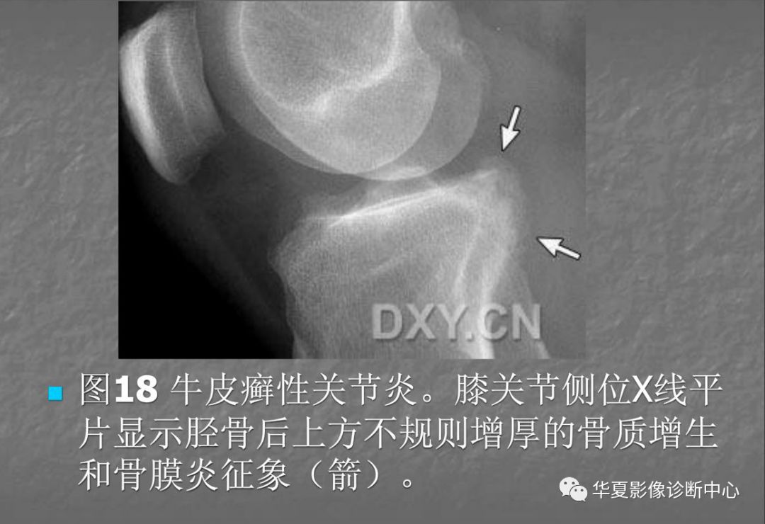 关节炎的x线评价