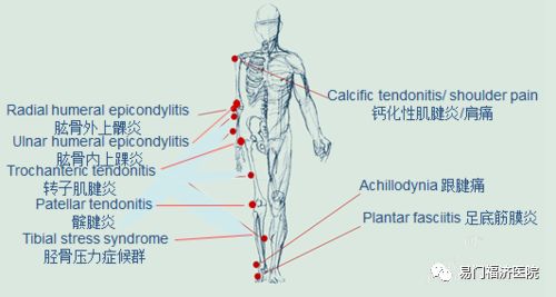 肱二头肌长头肌腱炎,钙化性冈上肌腱炎,肱骨外上髁炎,肱骨内上髁炎