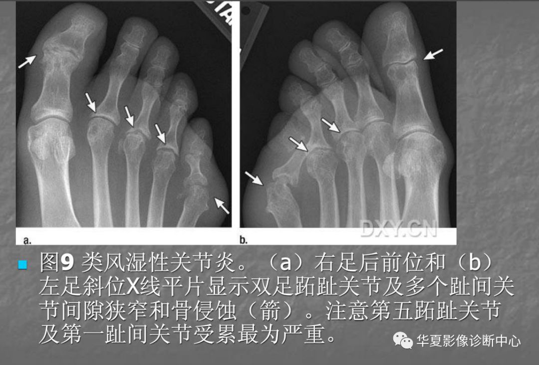 关节炎的x线评价