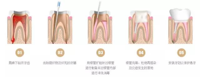 牙齿有牙虫怎么办