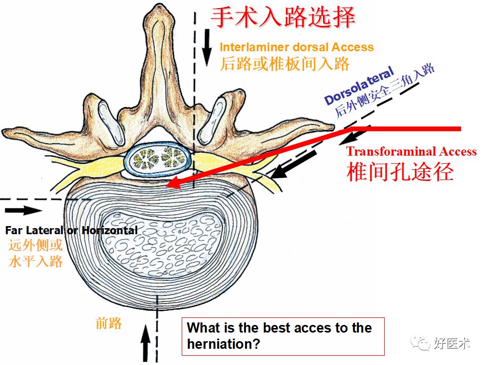 椎间孔镜技术的操作技巧及要点