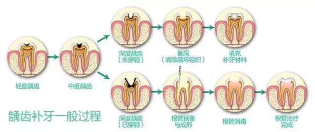 牙齿有牙虫怎么办