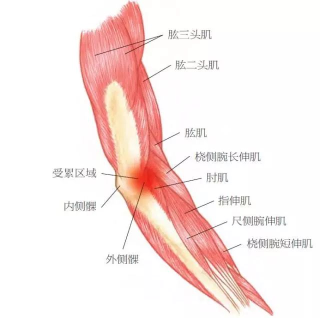 一般认为,手臂长时间过度使用,长期劳累,容易诱发伸肌肌腱微损伤.