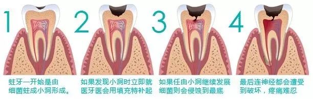 牙齿有牙虫怎么办