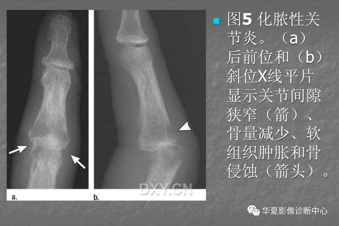 关节炎的x线评价