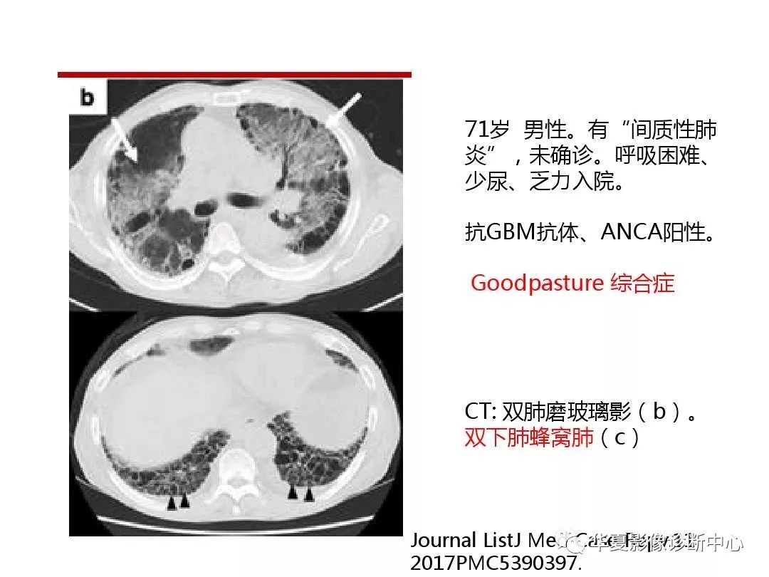 肺泡出血综合征ct表现