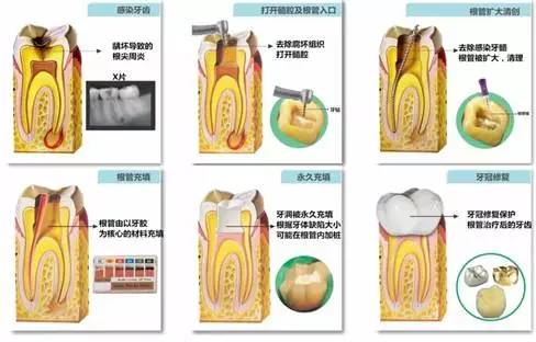 牙齿有牙虫怎么办