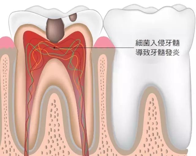 牙齿有牙虫怎么办