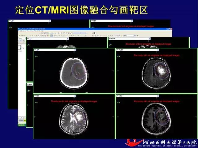 课件脑胶质瘤放疗原则及靶区勾画