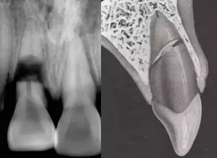 不像牙冠折断这样直观,牙根折断尤其是深部的牙根折断常常没有自觉