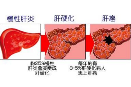 大部分肝硬化患者会出现出血的现象,并且会反反复复的鼻子流血,皮肤