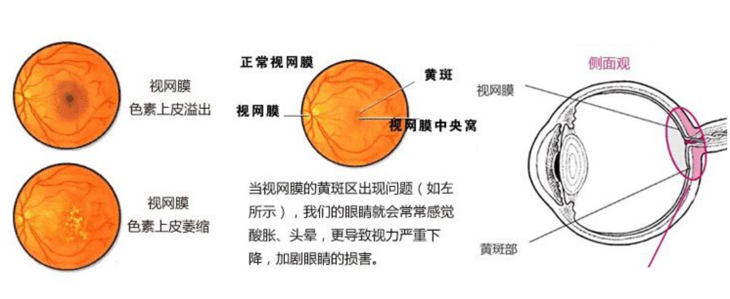 眼球在瞬间受到如此冲击时, 会引起眼内液体剧烈震动, 对周围组织