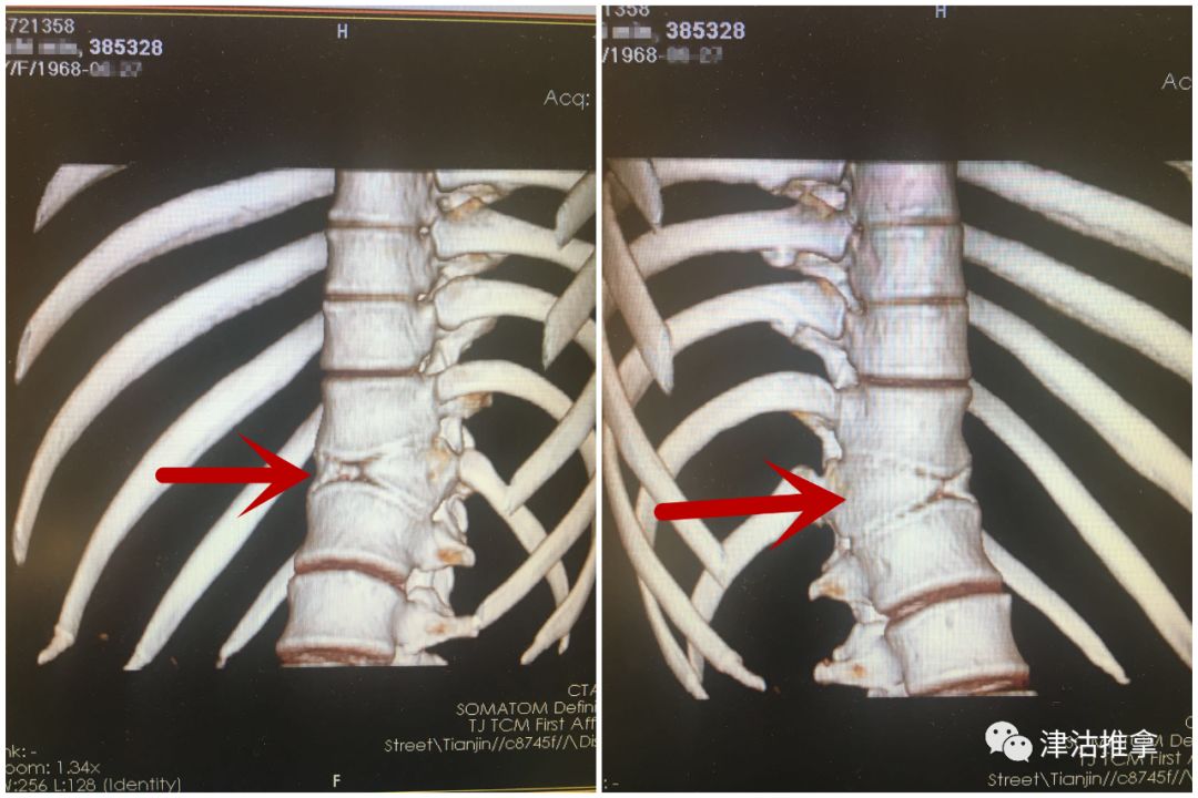 来看看胸椎ct 三维立体重建结果这是什么?骨折吗?畸形吗?