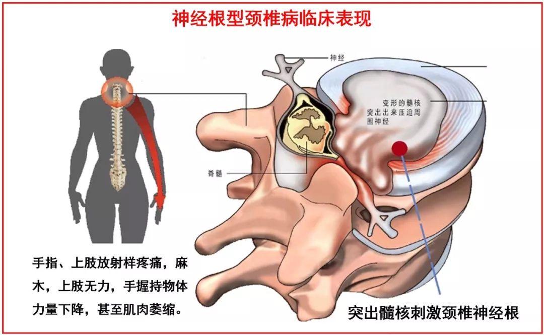 颈椎病变刺激或压迫到神经出现:手指,上肢放射样疼痛,麻木,如果长期