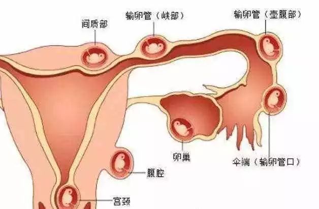 宫外孕通过观察白带,能初步判断是否有妇科炎症.