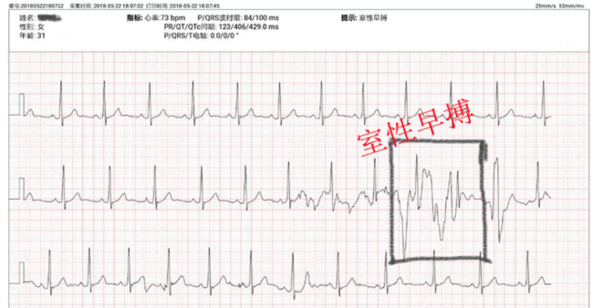 早搏人口_室性早搏心电图