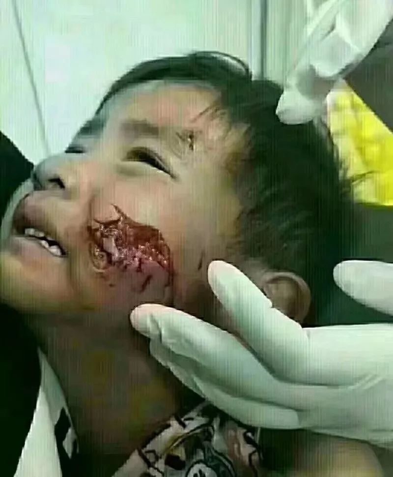 3岁小孩被狗咬伤半边脸?网警通报来了