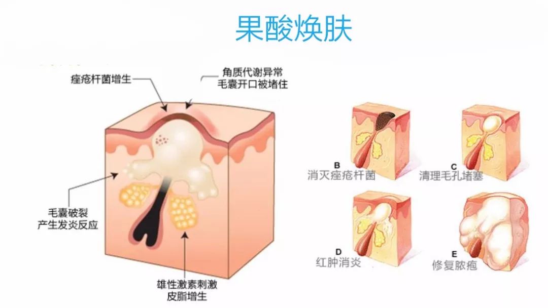 人口增生_疤痕增生图片(3)