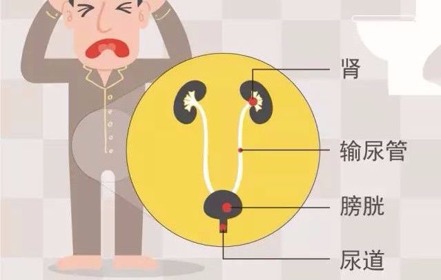 泌尿结石疼怎么办