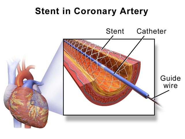 介入治疗(percutaneous transluminal coronary intervention,pci)