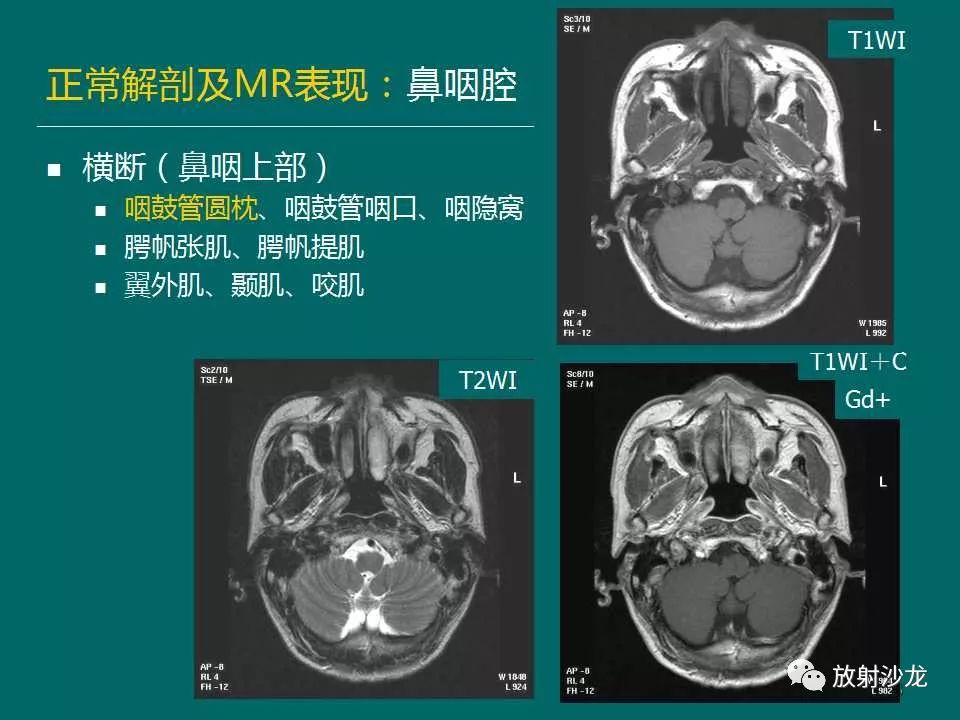 鼻咽癌的mri诊断