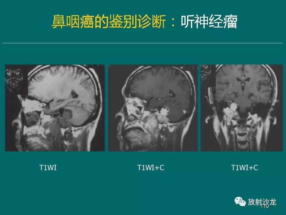 鼻咽癌的mri诊断