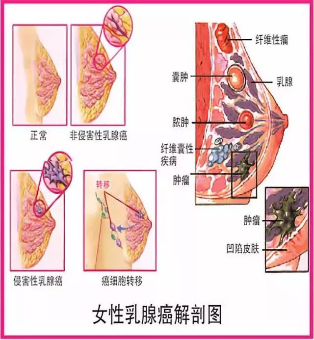 拿什么拯救你,我的乳腺!