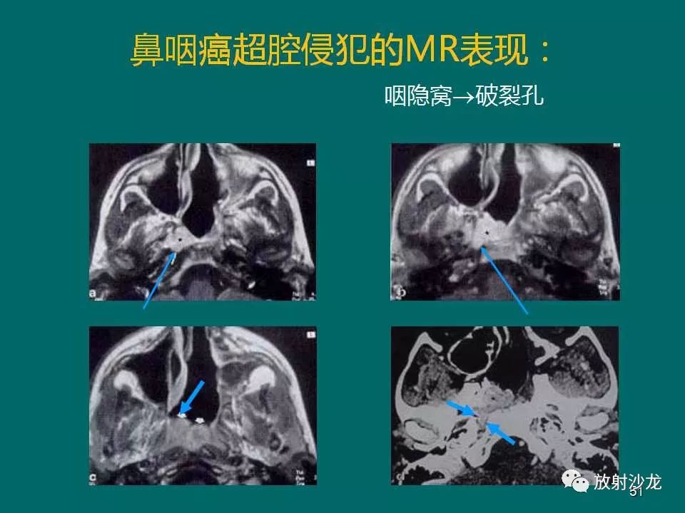 鼻咽癌的mri诊断