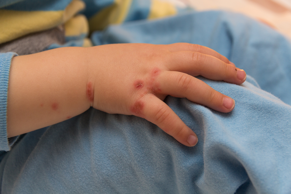 如何区分手足湿疹和手足癣 