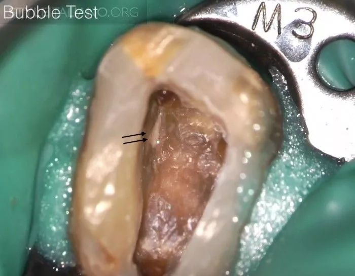 【牙医学堂】上颌磨牙mb2——是否真的存在?