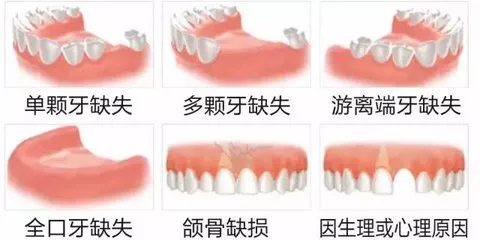 宝威体育官网：宝威体育下载网站：牙齿种植知多少(图1)