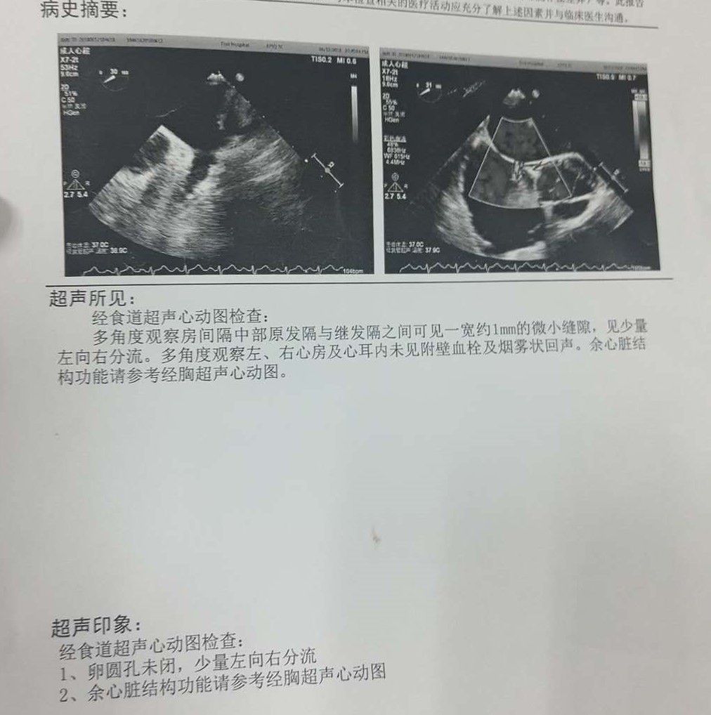 对比增强经颅内多普勒超声声学造影:阳性结果,提示右向左分流,见图2.