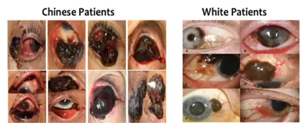 中国,高加索人群结膜黑色素瘤患者的典型临床表现.
