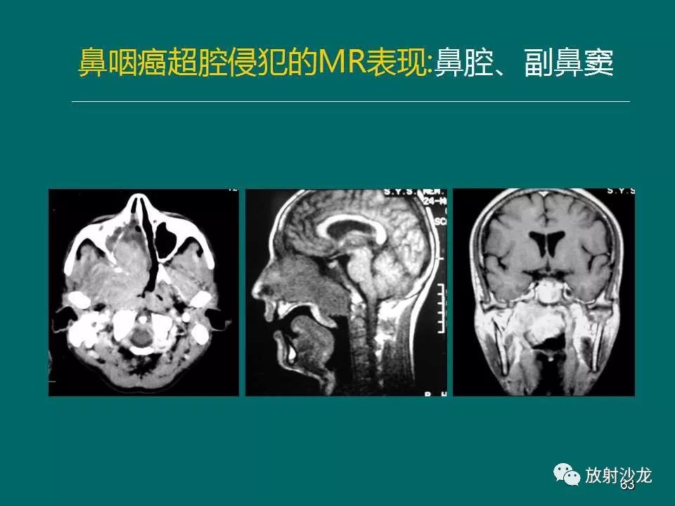 鼻咽癌的mri诊断